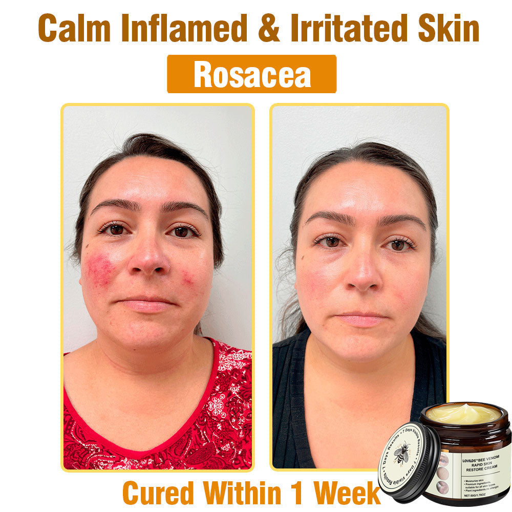 LOVILDS™ Bee Venom Total Skin Renewal Cream US Dermatologist Approved
