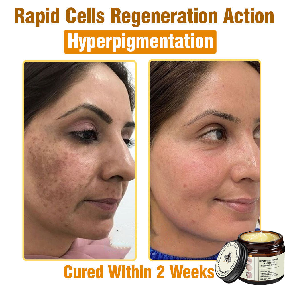 LOVILDS™ Bee Venom Total Skin Renewal Cream US Dermatologist Approved
