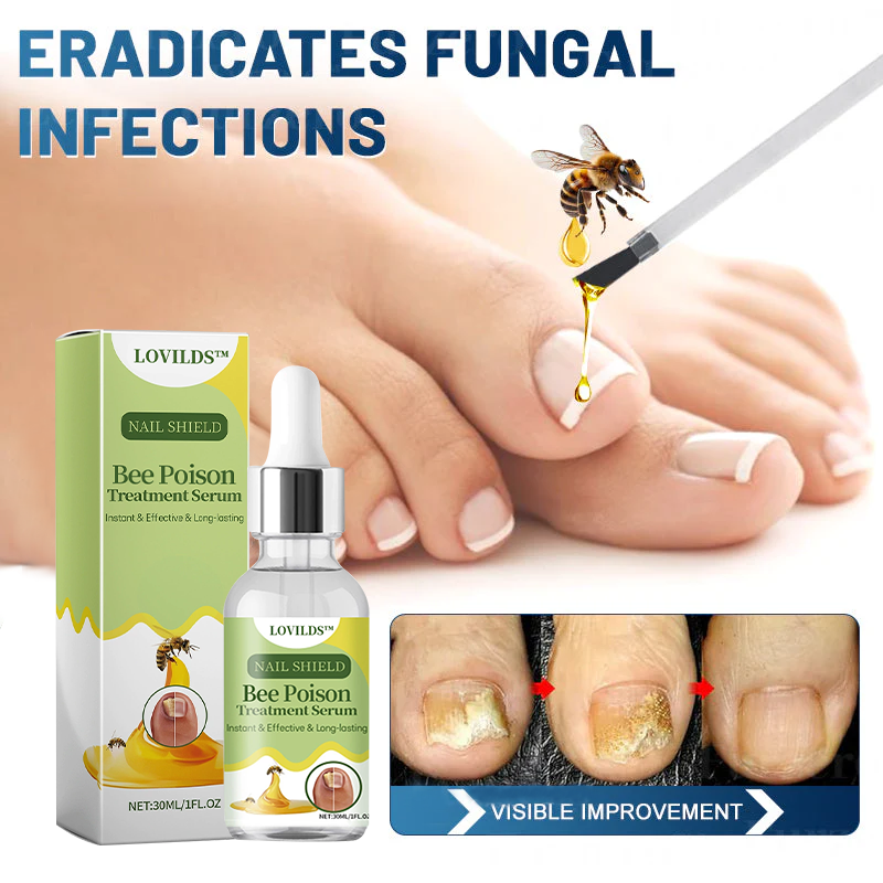 (🔥LAST DAY SALE-82% OFF) LOVILDS™ Nail Fungus Bee Poison Treatment Serum
