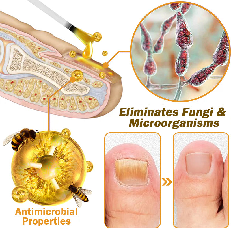 (🔥LAST DAY SALE-82% OFF) LOVILDS™ Nail Fungus Bee Poison Treatment Serum