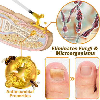 (🔥LAST DAY SALE-82% OFF) LOVILDS™ Nail Fungus Bee Poison Treatment Serum