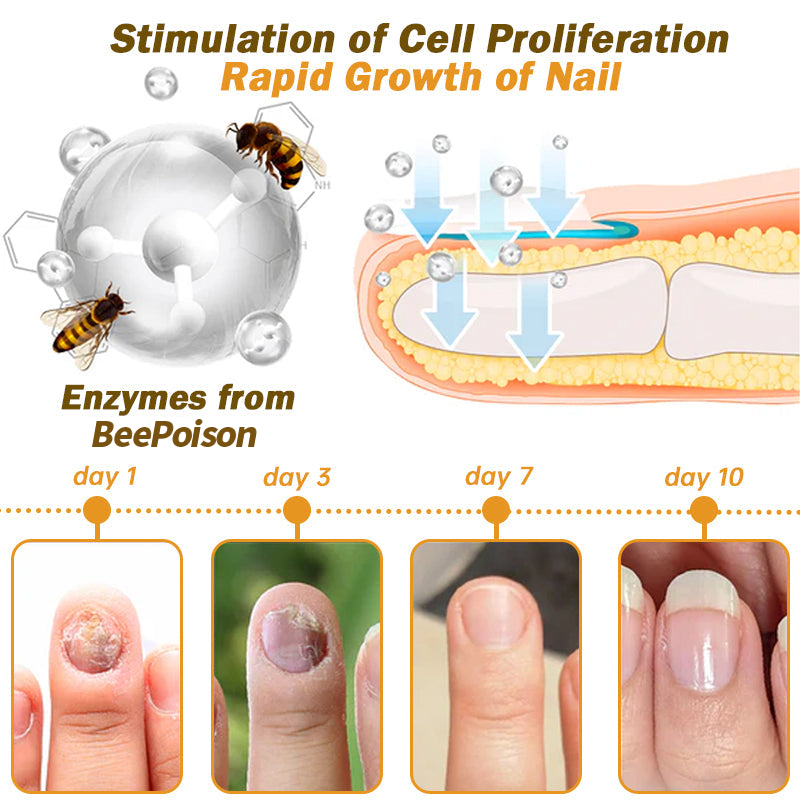 (🔥LAST DAY SALE-82% OFF) LOVILDS™ Nail Fungus Bee Poison Treatment Serum
