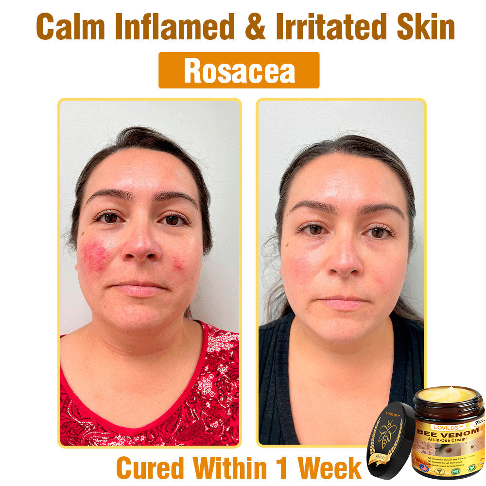 LOVILDS™ Bee Venom All-in-One Cream US Dermatologist Approved